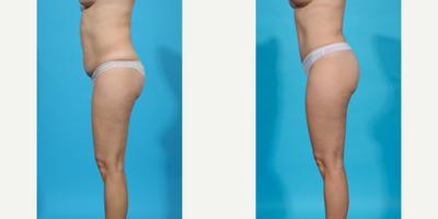35-44 year old woman treated with Abdominal Etching, Diastasis Recti Repair, Drainless Tummy Tuck, Laser Liposuction, Liposculpt - Before and after Mommy Makeover breast augmentation. This patient wanted a breast augmentation as part of her mommy makeover. She had some volume loss, sagging, and asymmetry after multiple pregnancies. I did a dual plane breast augmentation to help the implants and breast tissue perfectly align. I used a silicone gel gummy bear SoftTouch implant sized 275cc moderate profile. She has the fullness and shape she wants and much better symmetry.
