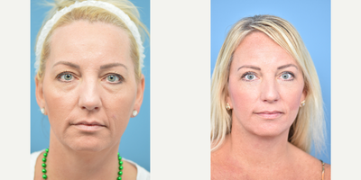 45-54 year old woman treated with Cheek Lift - This patient underwent a Cheek Lift and upper and lower blepharoplasty. Her neck and jawline are now more redefined. Her eyes are more open and she looks more rested.