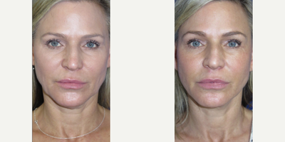Woman treated with Nonsurgical Facelift, Nonsurgical Neck Lift - This beautiful patient came to us seeking facial rejuvenation to reverse signs of aging. We performed a FaceologyLIFT which significantly lifted her neckline, tightened her skin, and redefined her jawline.This procedure is done under local anesthesia, with a small incision that is hidden along the hairline and margins of the ear, allowing a rapid and easy recovery.