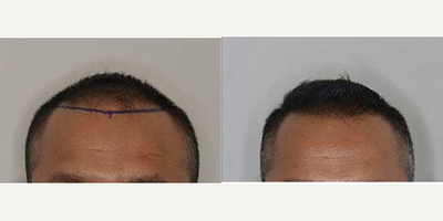 35-44 year old man treated with Hair Transplant - Before and after 1300 FUE grafts to reinforce and lower hairline in a 42-year-old male.