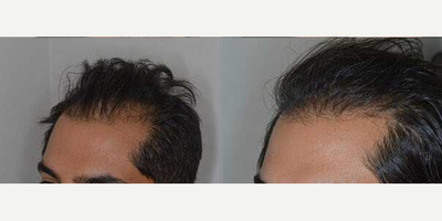 35-44 year old man treated with Hair Transplant - Before and after 1800 FUE grafts to fill in the density in the frontal area and the temporal recessions in a 40-year-old male