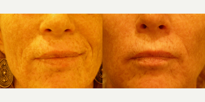 45-54 year old woman treated with Affirm Laser - 54 year old smoker patient who had her parenthesis lines treated with Affirm.