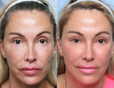 45-54 year old woman treated with Eyelid Retraction Repair - 53 year old woman with concerns about her eyes after having had unsatisfactory upper and lower eyelid surgery.Diagosis: 1. S/P bilateral lower eyelid surgery with fat grafting 2. S/P Revisional right lower eyelid surgery 3. S/P Bilateral lower blepharoplasty with removal of grafted fat. 4. Vertical and horizontal inadequacy of the lower eyelids Treatment: Bilateral lower eyelid/midface reconstruction in staged surgery with ePTFE orbital rim implant, hard palate graft, and midface lift. Bilateral upper eyelid reconstruction.