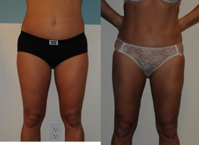 LIposuction - 
	Liposuction of Thighs and Abdomen
