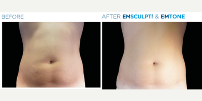 35-44 year old woman treated with Emsculpt - 35-44 year old woman treated with Emsculpt Neo (4 treatments)