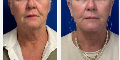 69 year old woman treated with Facelift, CO2 Laser - 69 year old woman treated with Facelift and CO2 Laser under IV sedation.