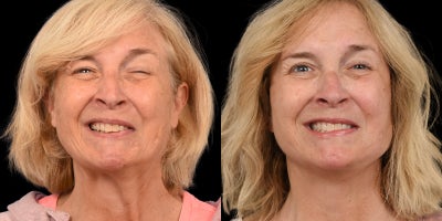 45-54 year old woman treated with Facial Reconstructive Surgery - Before & After Left Facial Paralysis and Synkinesis Correction: Selective Neurolysis, Deep Plane Facelift & Platysma Myectomy
