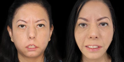 45-54 year old woman treated with Facial Reconstructive Surgery - Before & After: Single-Stage Facial Reanimation and Aesthetic Reshaping for Moebius Syndrome with Buccal Fat Repositioning
