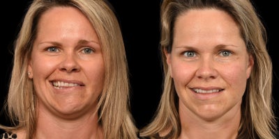 35-44 year old woman treated with Facial Reconstructive Surgery - Before & After Left Facial Paralysis and Synkinesis due to Facial Hemangioma: Selective Neurolysis, Brow Lift & Deep Plane Facelift