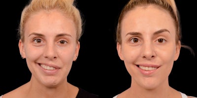 25-34 year old woman treated with Facial Reconstructive Surgery - Before & After Revision Selective Neurolysis: Advanced Facial Reanimation for Synkinesis