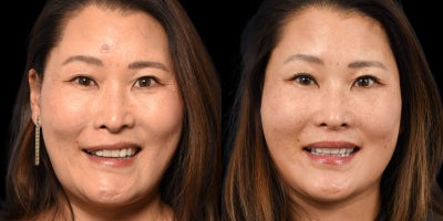 35-44 year old woman treated with Facial Reconstructive Surgery - Before & After Facial Reanimation: Left Brow Lift and Selective Neurolysis After Brain Tumor - Meningioma Surgery