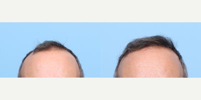 45-54 year old man treated with FUE Hair Transplant, Hair Transplant, Hair Loss Treatment, PRP for Hair Loss - This 45-year-old patient expressed frustration that he had lost so much hair and wanted all the thinner areas of his hair to look thicker and fuller. Dr. Wise performed an FUE hair transplant and one session of PRP therapy during the procedure. At just 6 months, he is well on his way to looking more his younger self again, with a full head of hair. His growth will continue to fill in over the next 6 months.