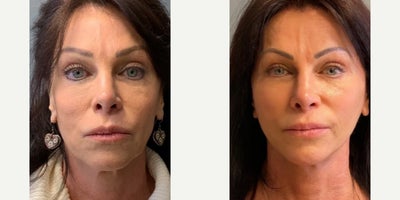 Woman treated with Facelift - Woman treated with Facelift and Neck Lift