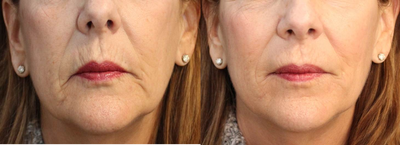 ArteFill - This woman wanted to improve her tired, sad look.  She also wanted the results to be natural and long lasting.   She decided to use Artefill to treat her upper lip and the marionette areas.  She is shown here at 3 months after treatment.