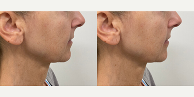 Woman treated with Microneedling - Woman treated with Microneedling using Vivace as well as CoolPeel to full face