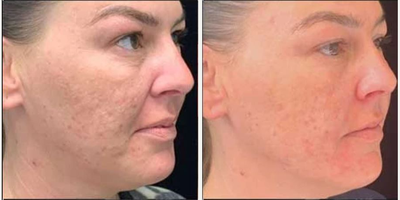 Woman treated with Secret RF - Woman treated with Secret RF.