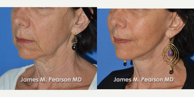 55-64 year old woman treated with Facelift - Patient underwent a Facelift with Dr. Pearson
