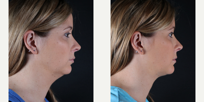 Double Chin CoolMini - Results shown after 2 sessions of CoolMini for a double chin