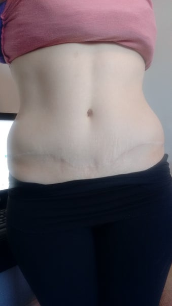 lipase c Before & After Cosmetic Surgery Gallery