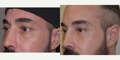 45-54 year old man treated with TCA Peel.  He also underwent a lower eyelid blepharoplasty - This 45 year old male had a customized TCA, Jessners peel.  His chief complaint was bags under his eyes as well as the crepe (finely wrinkled) skin of his lower eyelids. 
 He underwent a lower eyelid transconjunctival blepharoplasty with a lower eyelid pinch.  The post-operative photos are taken 5 weeks after surgery