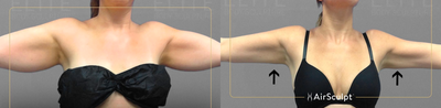 35-44 year old woman treated with AirSculpt - Thanks to the unique way that our patented procedure removes fat, this Nashville patient now enjoys toned, tighter arms after her treatment. Join our live session tomorrow to learn how Arm AirSculpt can help you kick-start a healthier lifestyle!