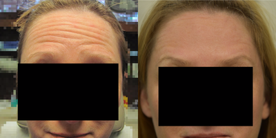 45-54 year old woman treated with Botox - 38 units of Botox Cosmetic used to treat Glabella, Forehead, and Crow's Feet.