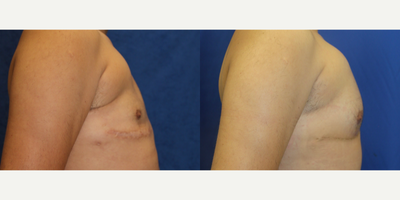35-44 year old man treated with Pec Implants - This is a 37 year old male patient who is 5'5 and 145 pounds. In 2007, he had raw silicone injected in his pectoral area which caused him problems. In November 2021, this patient traveled from Chicago to Beverly Hills to have Dr. Katzen remove the silicone. Later, this patient returned to Dr. Katzen to have pectoral implants. This patient is pleased with his results.