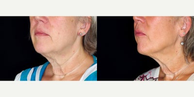 60 year old woman treated with Ultherapy to lower face and neck. - 60 year old woman treated with Ultherapy to lower face and neck. Photos depict before and 3 months after treatment.
