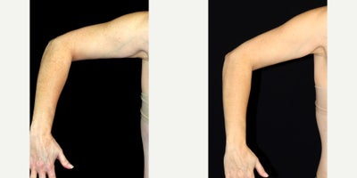 52 year old woman treated with Smart Lipo to arms - 52 year old woman treated with Smart Lipo to arms. Photos depict before and 1 year after surgery.
