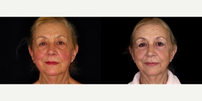 78 year old woman treated with Eyelid Surgery, Brow Lift, Facelift, CO2 Laser - 78 year old woman treated with Eyelid Surgery, Brow Lift, Facelift, CO2 Laser.  Photos depict before and 7 months after surgery.