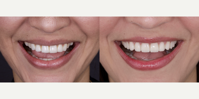 35-44 year old woman treated with Smile Makeover, Lumineers - woman treated with Porcelain Veneers