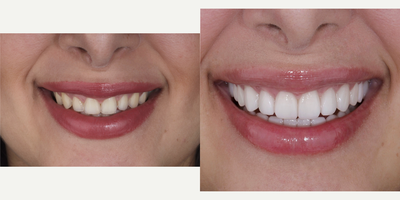 25-34 year old woman treated with Lumineers, Porcelain Veneers - woman treated with Porcelain Veneers