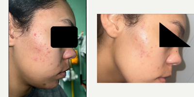 18-24 year old woman treated with Retin-A - Retin-A works by promoting the turnover of skin cells, which helps to prevent the clogging of pores and reduce the formation of acne lesions. It can also help to reduce the appearance of fine wrinkles and mottled skin discoloration, and to make rough facial skin feel smoother.While Retin-A can be very effective, it can also cause side effects, including skin redness, dryness, itching, scaling, mild burning, or worsening of acne during the first 2 to 4 weeks of using the medication. These side effects usually decrease with continued use of the medication.It's important to use Retin-A exactly as directed by your physician and to avoid exposure to sunlight or artificial UV rays, such as sunlamps or tanning beds, while using the medication, as it can make your skin more sensitive to UV rays.