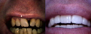 Porcelain Veneers - Full mouth Dental Porcelain Veneers, Mouth Make over, Smile make over done