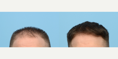 35-44 year old man treated with FUE Hair Transplant, Hair Transplant, Hair Loss Treatment, PRP for Hair Loss - This 42-year-old patient was unhappy with his hairline receding. Dr. Wise performed an FUE hair transplant, during which he transplanted 2,550 grafts to the front of the patient's scalp. The results are shown at one year post-op.