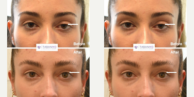 Young woman underwent droopy eyelid ptosis surgery. - Young woman, with tired appearing eyes due to asymmetric droopy upper eyelids (ptosis), underwent upper eyelid ptosis surgery and upper blepharoplasty.
