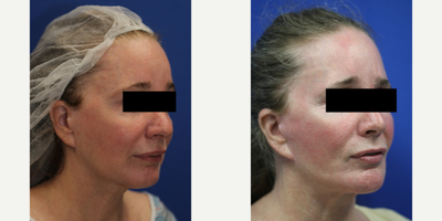 55-64 year old woman treated with Silicone Injection Removal - Meet our resilient patient, a 55-year-old white female standing at 5'1 and weighing 117 pounds. She had silicone injected into her face and unfortunately experienced numerous health issues as a result. Concerned for her wellbeing, she turned to the renowned Dr. J. Timothy Katzen in Beverly Hills, CA, for help.Dr. Katzen skillfully removed the silicone from her face, providing her with much-needed relief. Our patient now feels much better and is grateful for the compassionate care she received. Her journey is a reminder of the importance of seeking out qualified professionals when considering cosmetic procedures and the potential dangers of unregulated treatments.
