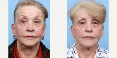 75 and up year old woman treated with Ultherapy - At 80 years old, this patient has noticeable lifting and tightening of the skin with Ultherapy, achieving a refreshed and rejuvenated appearance.