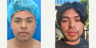 25-34 year old man treated with Botox, Buccal Fat Removal, Chin Liposuction, Laser Liposuction, Renuvion, Liposuction, Liposculp - This is a young gentleman who came to us seeking better skin and a slimmer more sculpted mid and lower face as well as chin, neck, and jawline. Under local anesthesia and oral sedation pills we removed his buccal fat pads, sculpted away excess fat from the chin, neck, and jawline using PRECISION SCULPT, shrunk the lower jaw masseter muscles using the neurotoxin botox, and started him on a daily skin care routine. He is shown before and four years after the procedure.