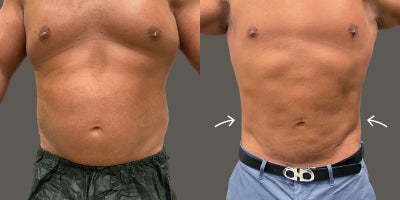 35-44 year old man treated with AirSculpt - This male patient got Stomach AirSculpt which is fat removal from the upper lower and waist. This procedure was done in the Philadelphia location and results are 6 months post-op.