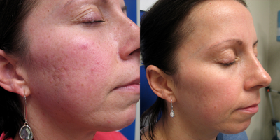 35-44 year old woman treated with IPL - IPL for rosacea after 6 treatments