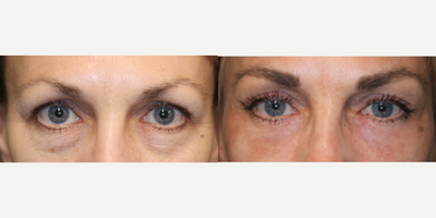Enigmalift Upper and Lower Eyelids - Enigmalift upper and lower eyelids with browlift and laser and lower eyelid tightening.