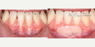 18 year old patient treated with gingival graft - Male patient with recession due to trauma.  Tissue grafting (from the palate) technique was used to cover root exposure.
