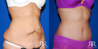 Tummy Tuck - Tummy Tuck