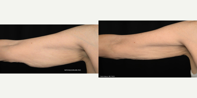 55-64 year old woman treated with Thermage - Patient complained of not being able to wear sleeveless garments and felt uncomfortable in bathing suits.