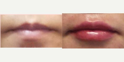 35-44 year old woman treated with Lip Fillers, Juvederm, Restylane, Volbella, Restylane Kysse - Lip augmentation with hyaluronic acid filler (Juvederm, Vollure, Volbella, Voluma, Restylane or Belotero) for balanced natural look & pout