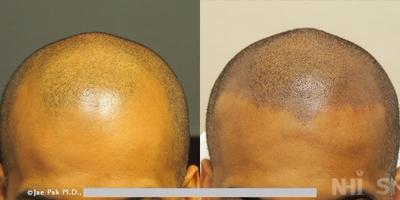 25-34 year old man treated with Scalp Micropigmentation - Scalp Micropigmentation