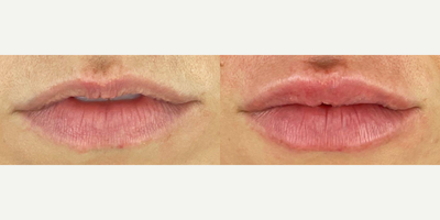 35-44 year old woman treated with Lip Fillers - Woman treated with lip fillers to add more volume to the top lip, photos show lips one week post procedure.