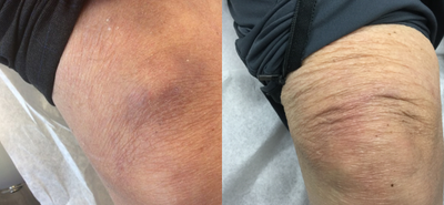 75 and up year old woman treated with Cyst Removal - 76 year old woman treated with cyst removal, results shown after 11 weeks.