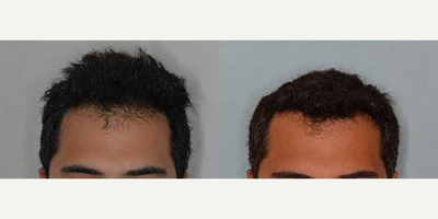 Man treated with Hair Transplant, FUE Hair Transplant - Before and after 1200 FUE grafts to reinforce and lower the hairline.